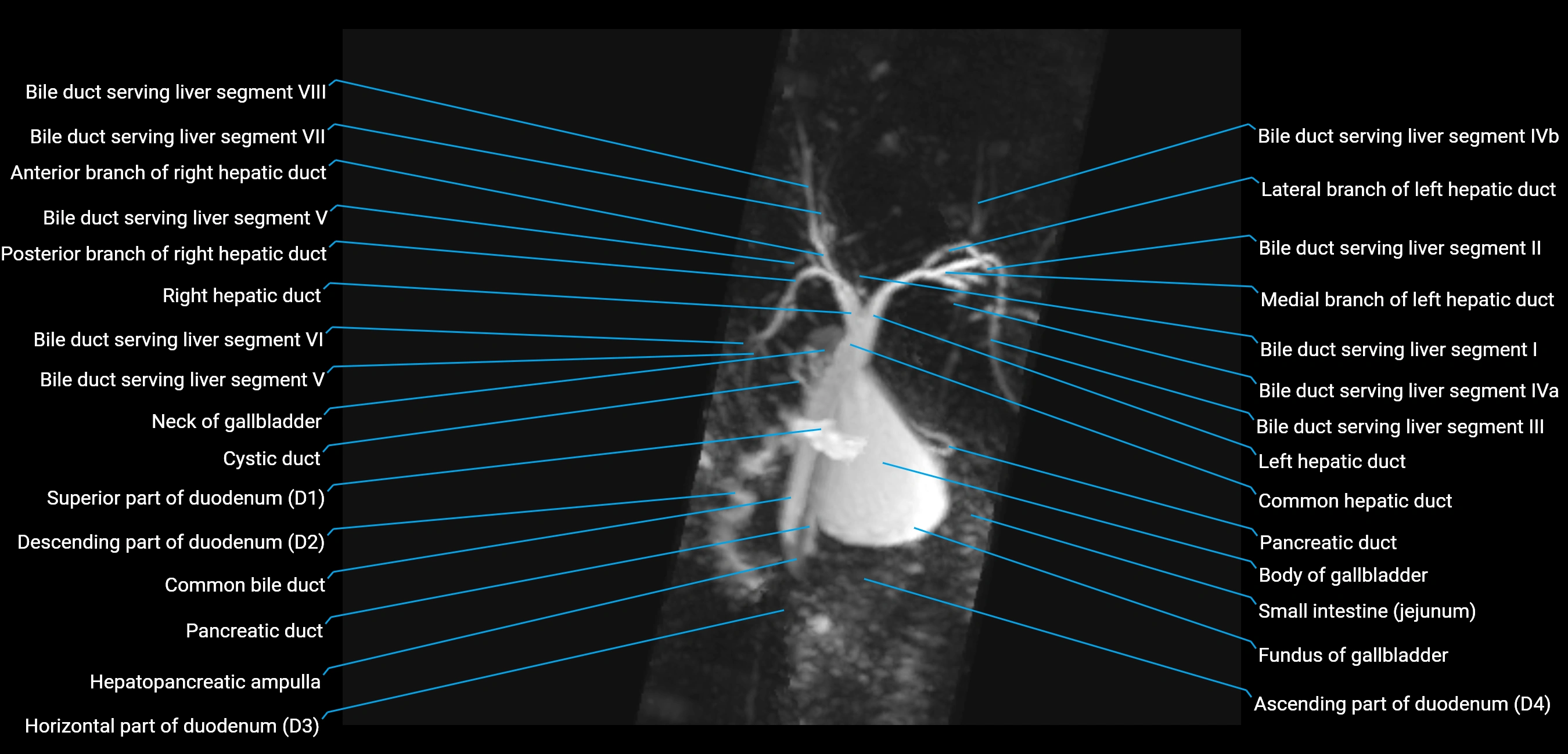 MRCP MIP MRI  anatomy labelled image-img-01003-00019.webp
